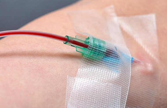 iv ozone therapy