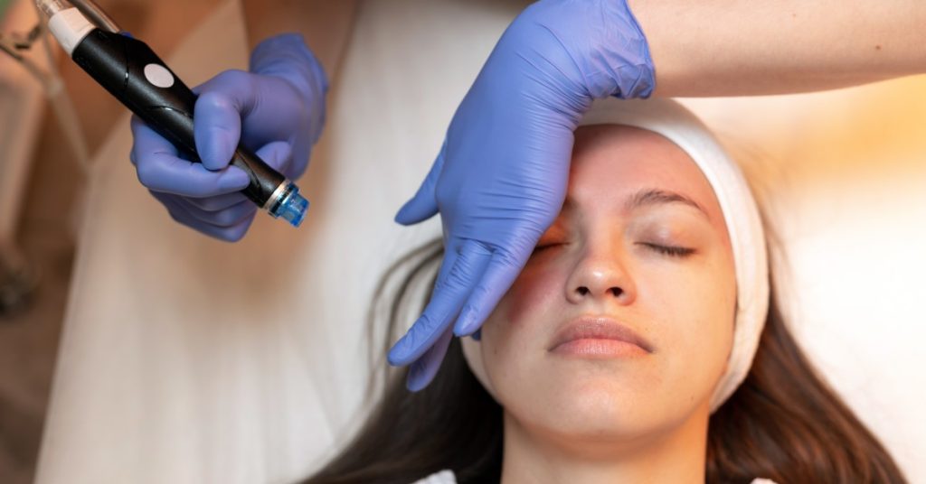 A woman with long brown hair is lying down on a white surface. There is a person holding a microneedling pen to her cheek.