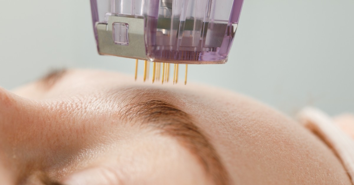 Microneedling vs. Botox: Which Is Better for Aging?