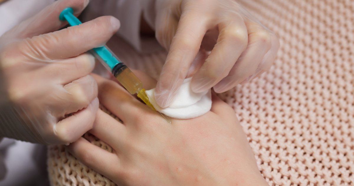 PRP Side Effects & Recovery: What You Should Know