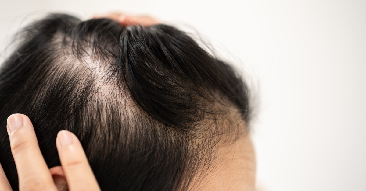 A person holds their long black hair to the side, clearly showing areas of thinning hair across their scalp.