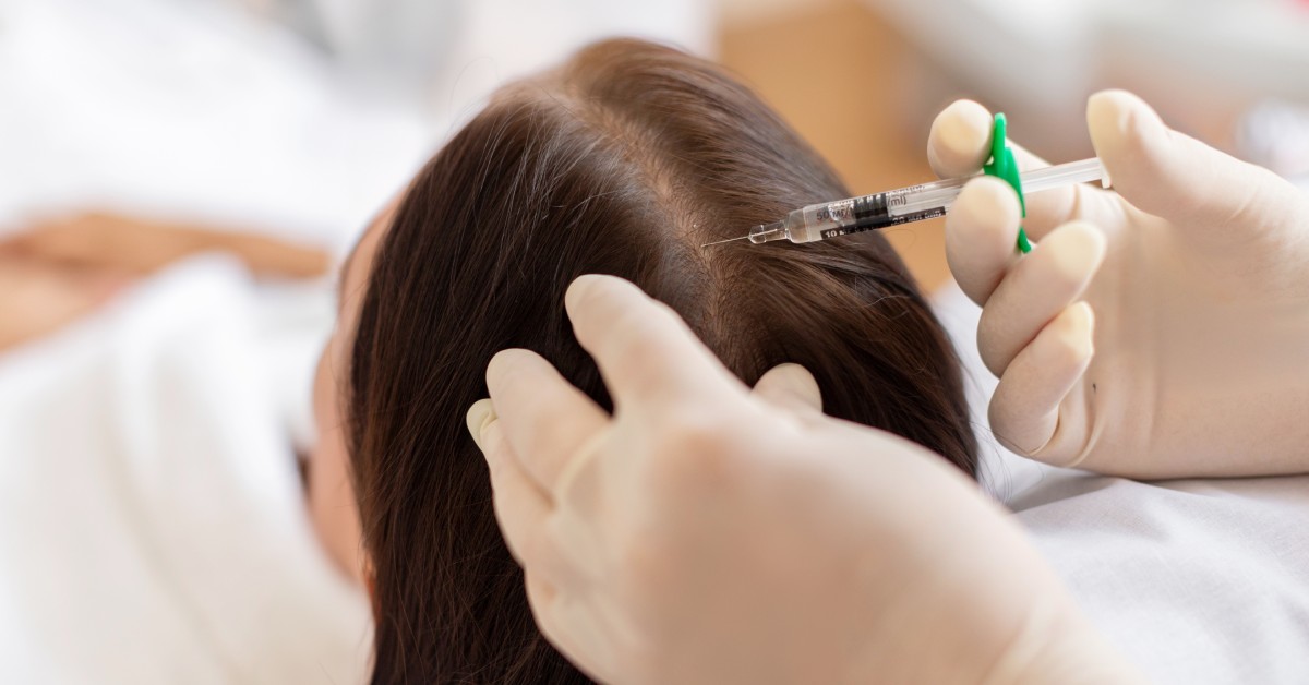 Can PRP Injections Work for Hair Growth?