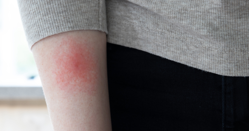 Persistent Symptoms After Lyme Treatment: When Your Doctor Says You’re Fine but You Don’t Feel Fine